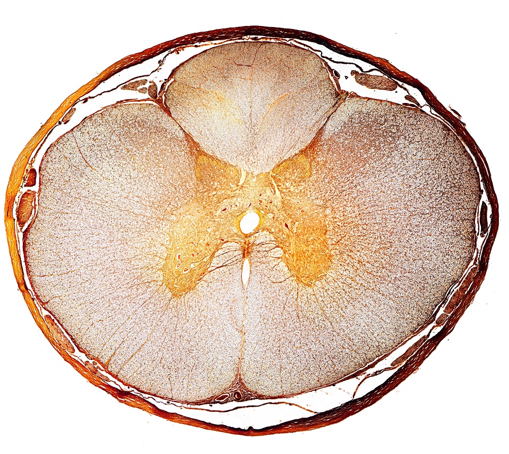 Avances en el tratamiento de la lesión de médula espinal